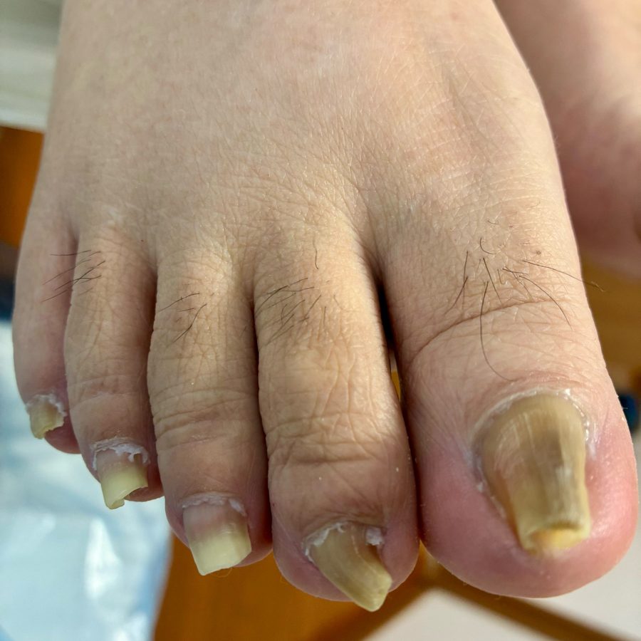 巻き爪ケアのビフォー
